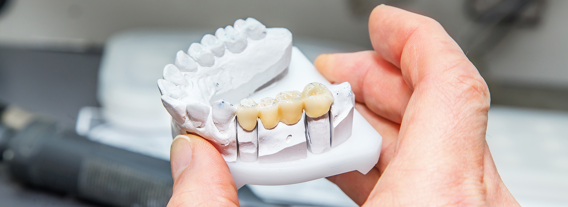 A person holding a 3D printed dental implant model.