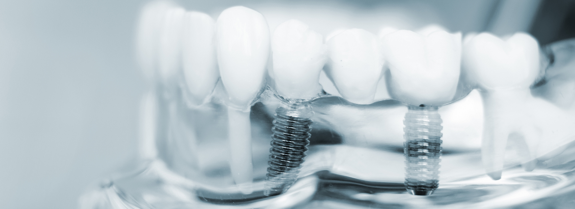 The image shows a close-up of a dental implant with multiple screws and a clear plastic cover, highlighting the components used in dental prosthetics.